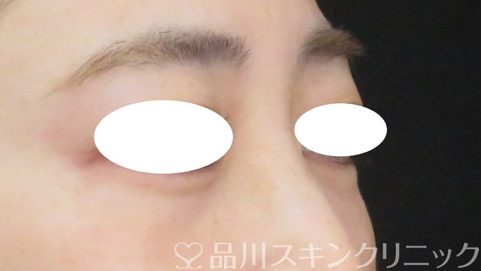 症例NO.70430のAFTER写真