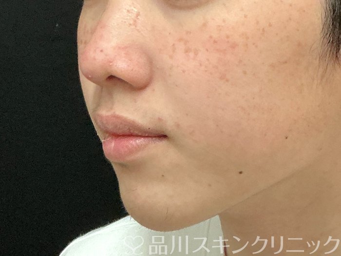 症例NO.73946のBEFORE写真