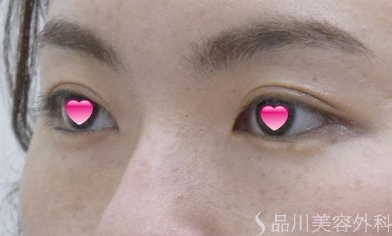 症例NO.52121のBEFORE写真