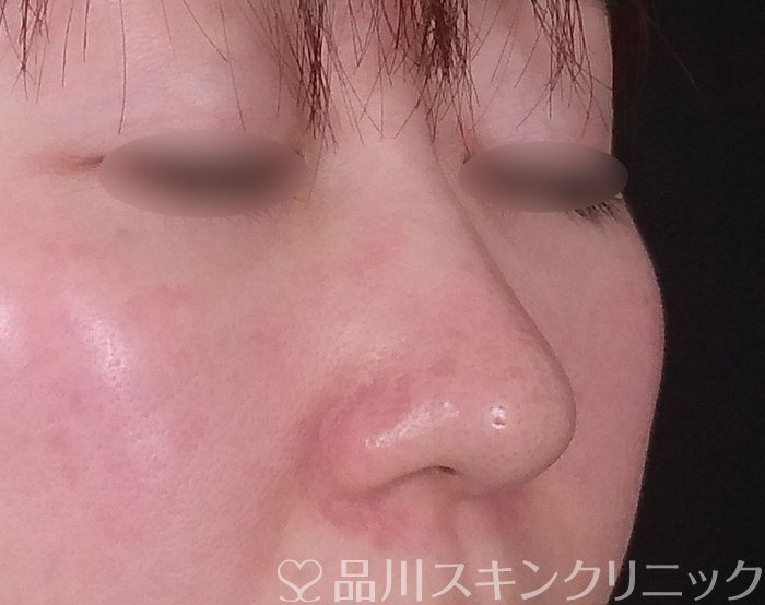 症例NO.68544のBEFORE写真