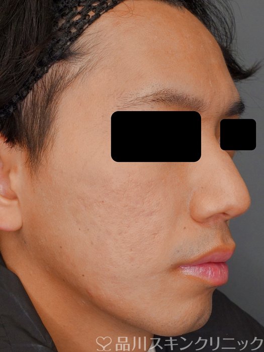 症例NO.73214のAFTER写真