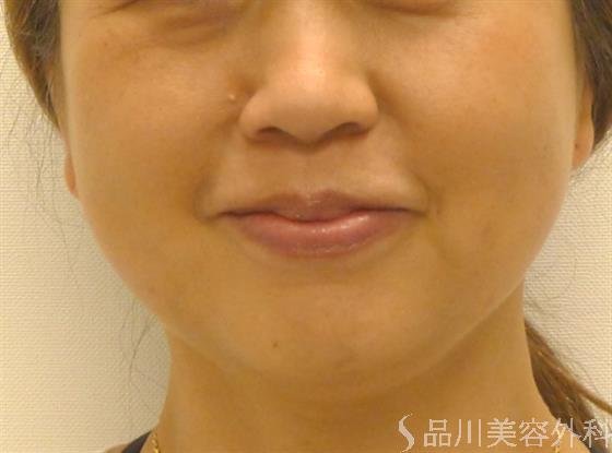 症例NO.40898のAFTER写真
