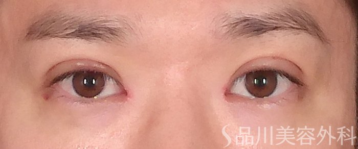 症例NO.72896のAFTER写真