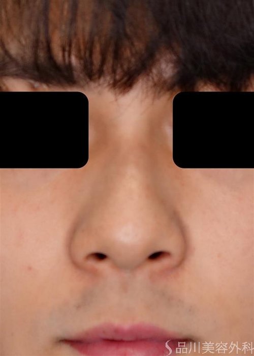 症例NO.51202のBEFORE写真