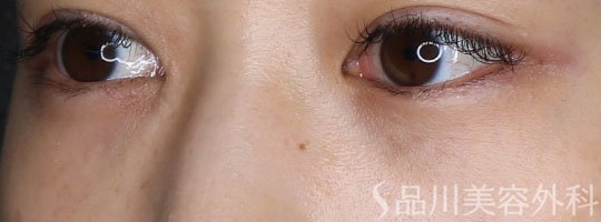 症例NO.72963のAFTER写真