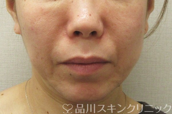 症例NO.75110のBEFORE写真