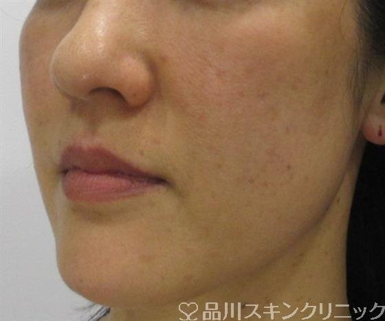 症例NO.32518のAFTER写真