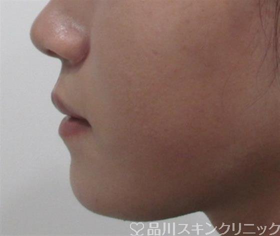 症例NO.30735のAFTER写真