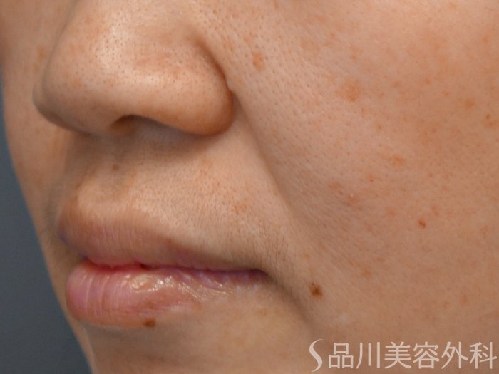 症例NO.67626のBEFORE写真