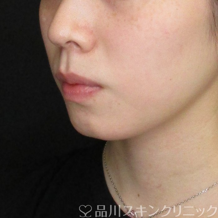 症例NO.74438のBEFORE写真