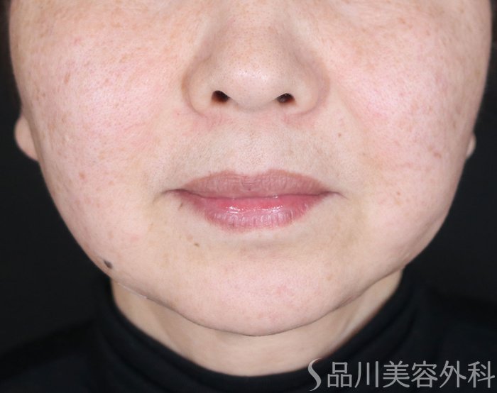 症例NO.73359のAFTER写真