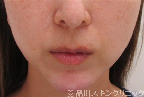 症例NO.43218のAFTER写真