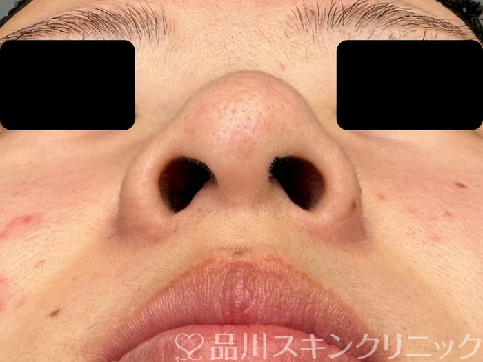 症例NO.62133のBEFORE写真