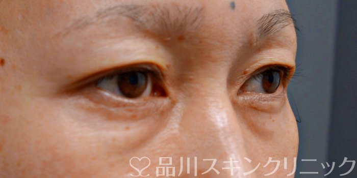 症例NO.74386のBEFORE写真