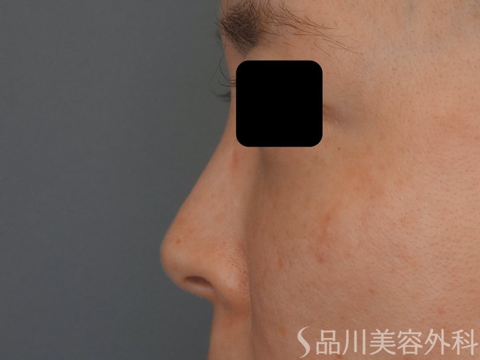 症例NO.69639のBEFORE写真