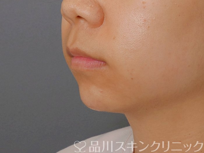 症例NO.71745のAFTER写真