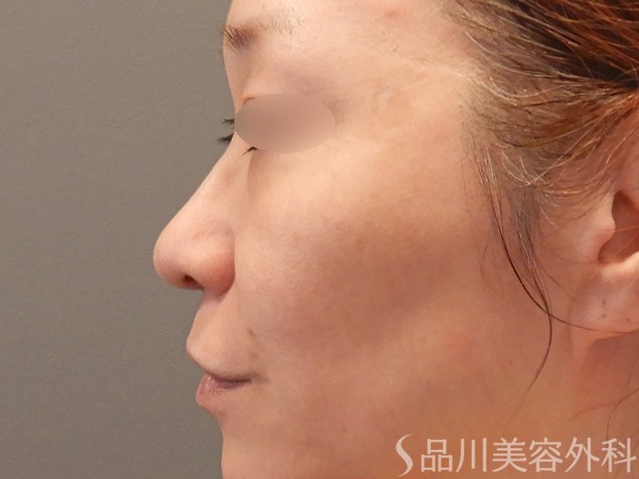 症例NO.70922のBEFORE写真