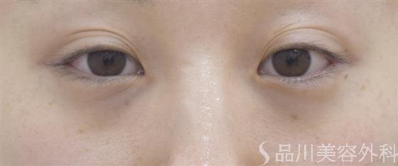 症例NO.43838のBEFORE写真