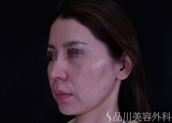 症例NO.70210のBEFORE写真
