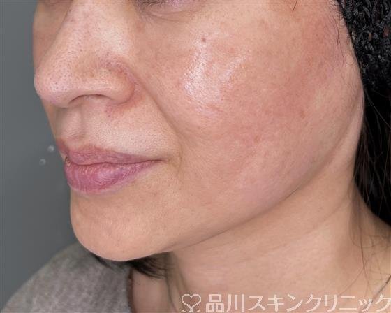 症例NO.55438のAFTER写真