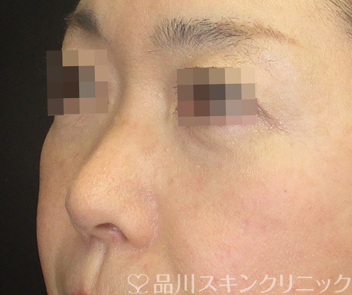 症例NO.73735のBEFORE写真