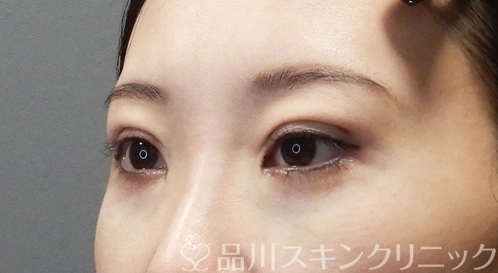 症例NO.72190のAFTER写真