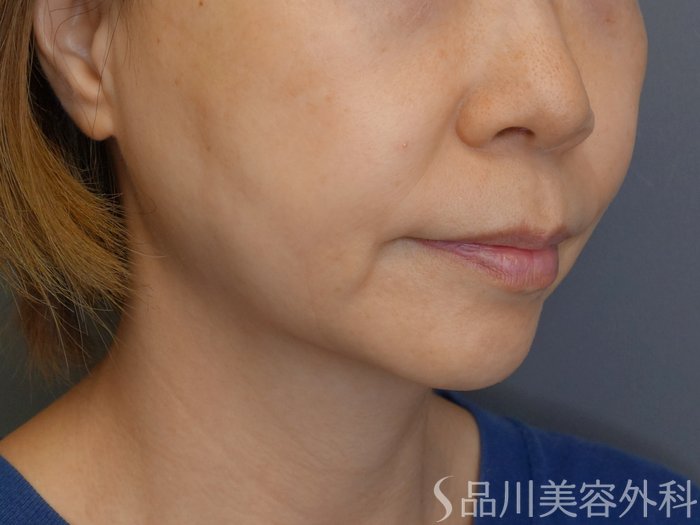症例NO.71733のBEFORE写真