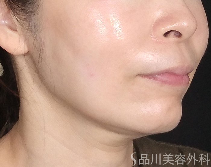 症例NO.70562のAFTER写真