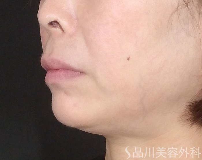 症例NO.65308のBEFORE写真