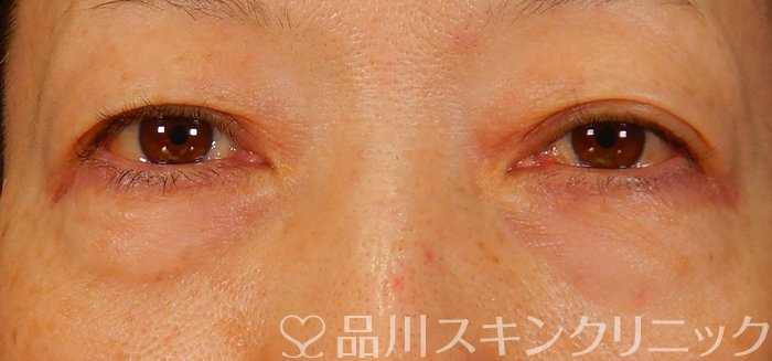 症例NO.64226のBEFORE写真