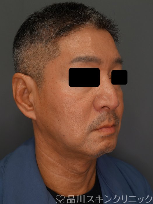 症例NO.74205のBEFORE写真
