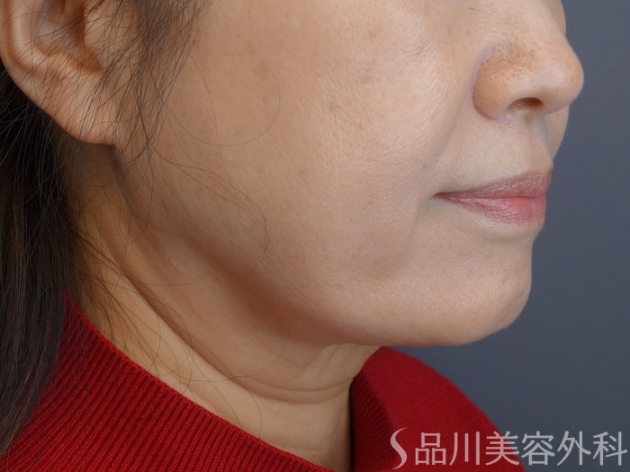 症例NO.72933のAFTER写真