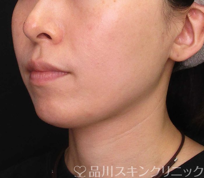 症例NO.70068のBEFORE写真