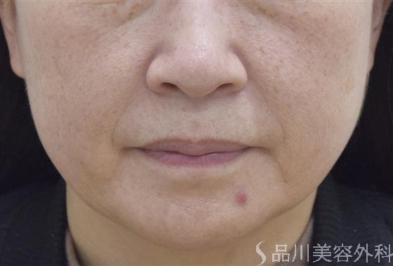 症例NO.51899のBEFORE写真