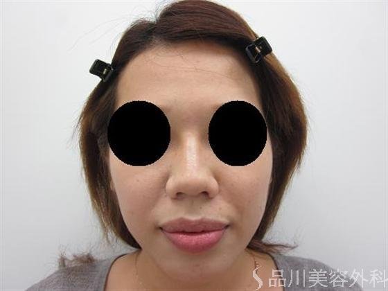 症例NO.10039のAFTER写真
