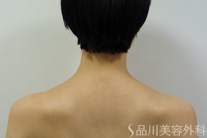 症例NO.71454のAFTER写真