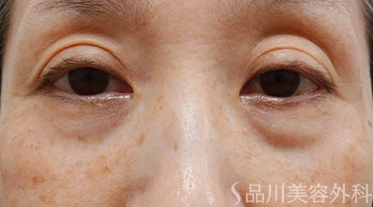 症例NO.69724のBEFORE写真
