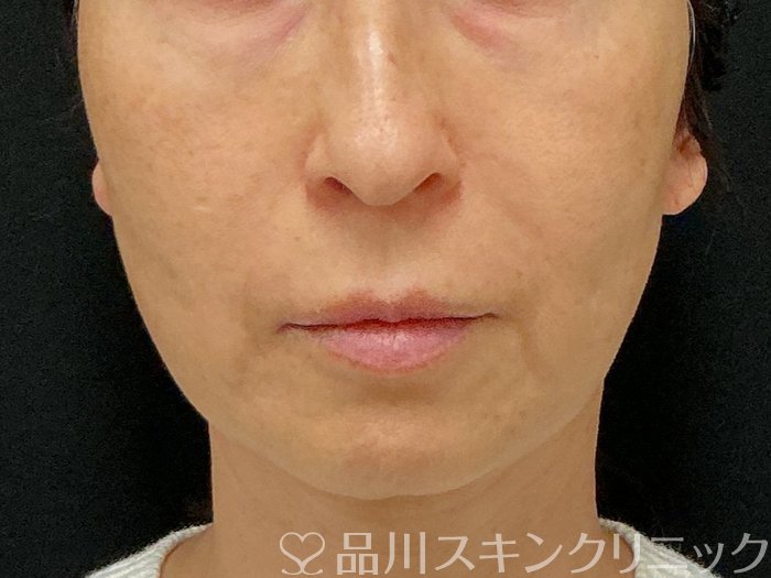 症例NO.74819のBEFORE写真