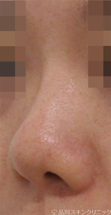 症例NO.37720のBEFORE写真