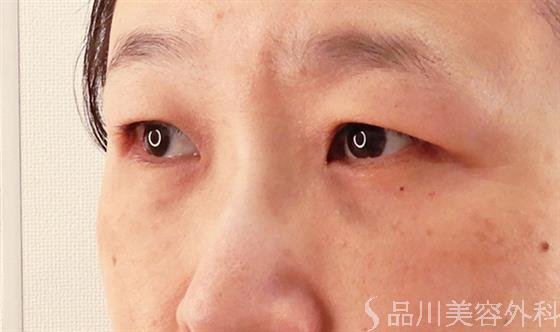 症例NO.61052のAFTER写真