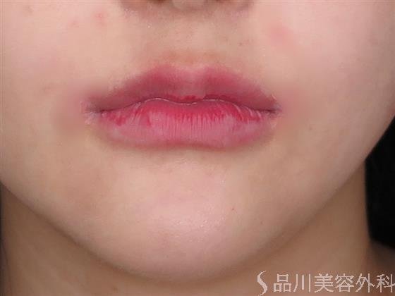症例NO.47705のAFTER写真