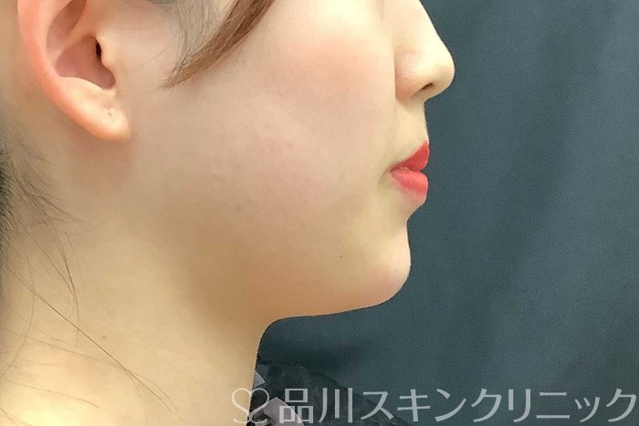 症例NO.69705のAFTER写真