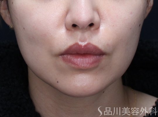 症例NO.73334のAFTER写真