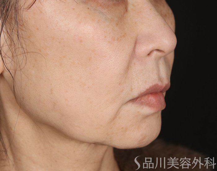 症例NO.73249のBEFORE写真