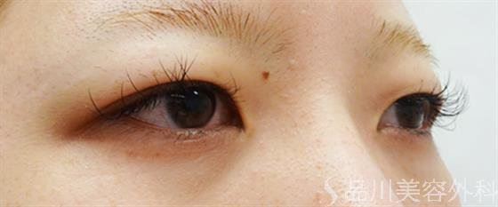 症例NO.49145のBEFORE写真