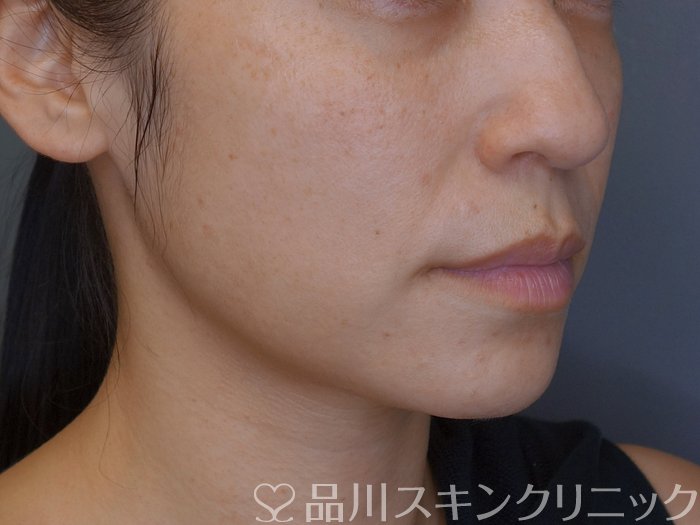 症例NO.74961のBEFORE写真