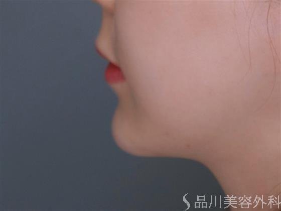 症例NO.51248のAFTER写真