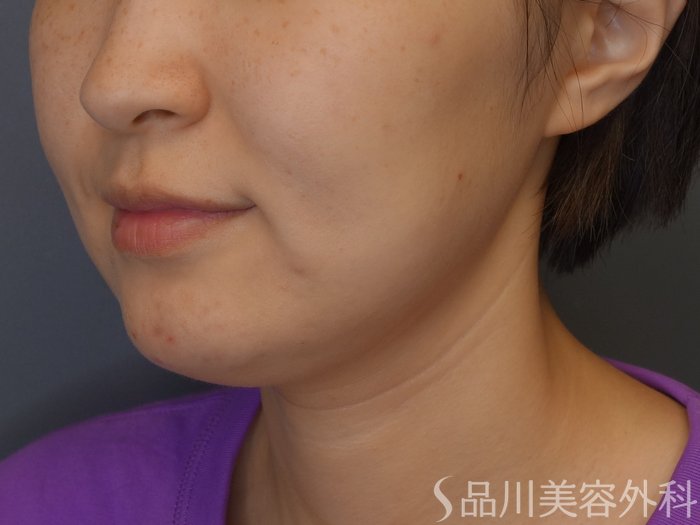 症例NO.67787のBEFORE写真