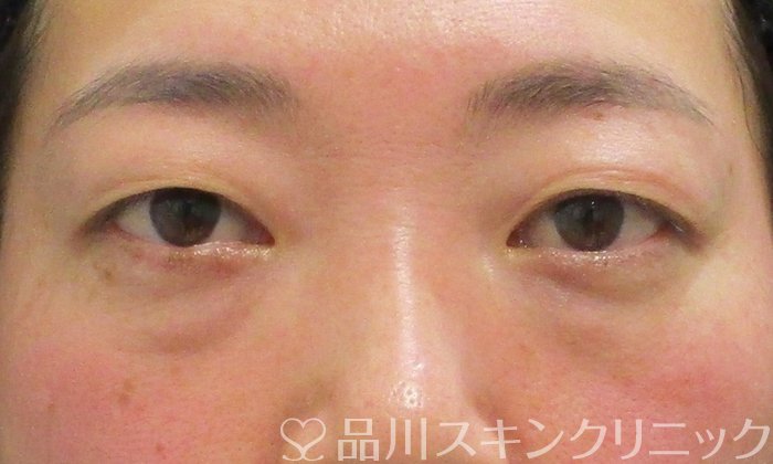 症例NO.69722のBEFORE写真