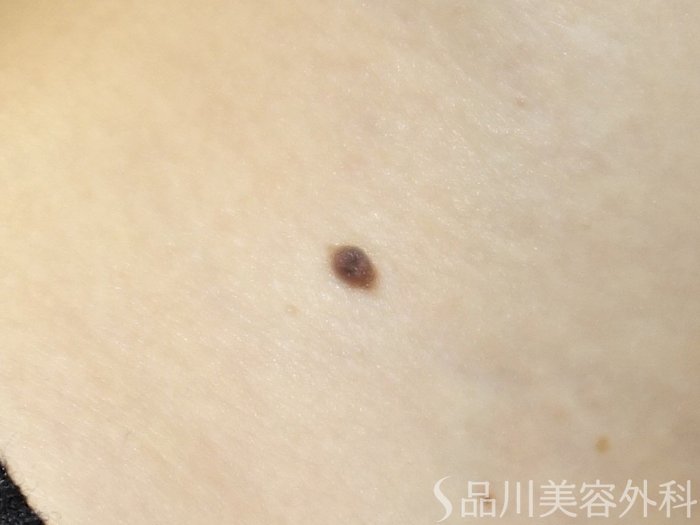 症例NO.68609のBEFORE写真